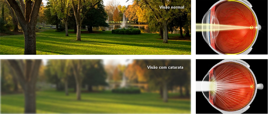 Imagem comparativa entre visão normal e visão com catarata